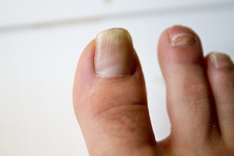 Does Alcohol Kill Toe Fungus?