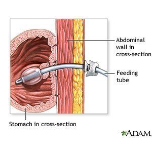 Can You Drink Alcohol With a Feeding Tube?