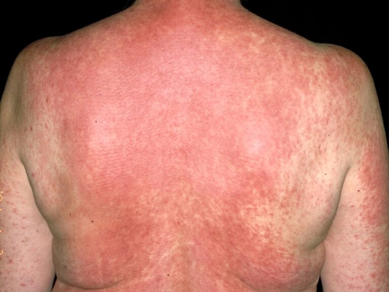 What Does a Drug Rash Look Like?