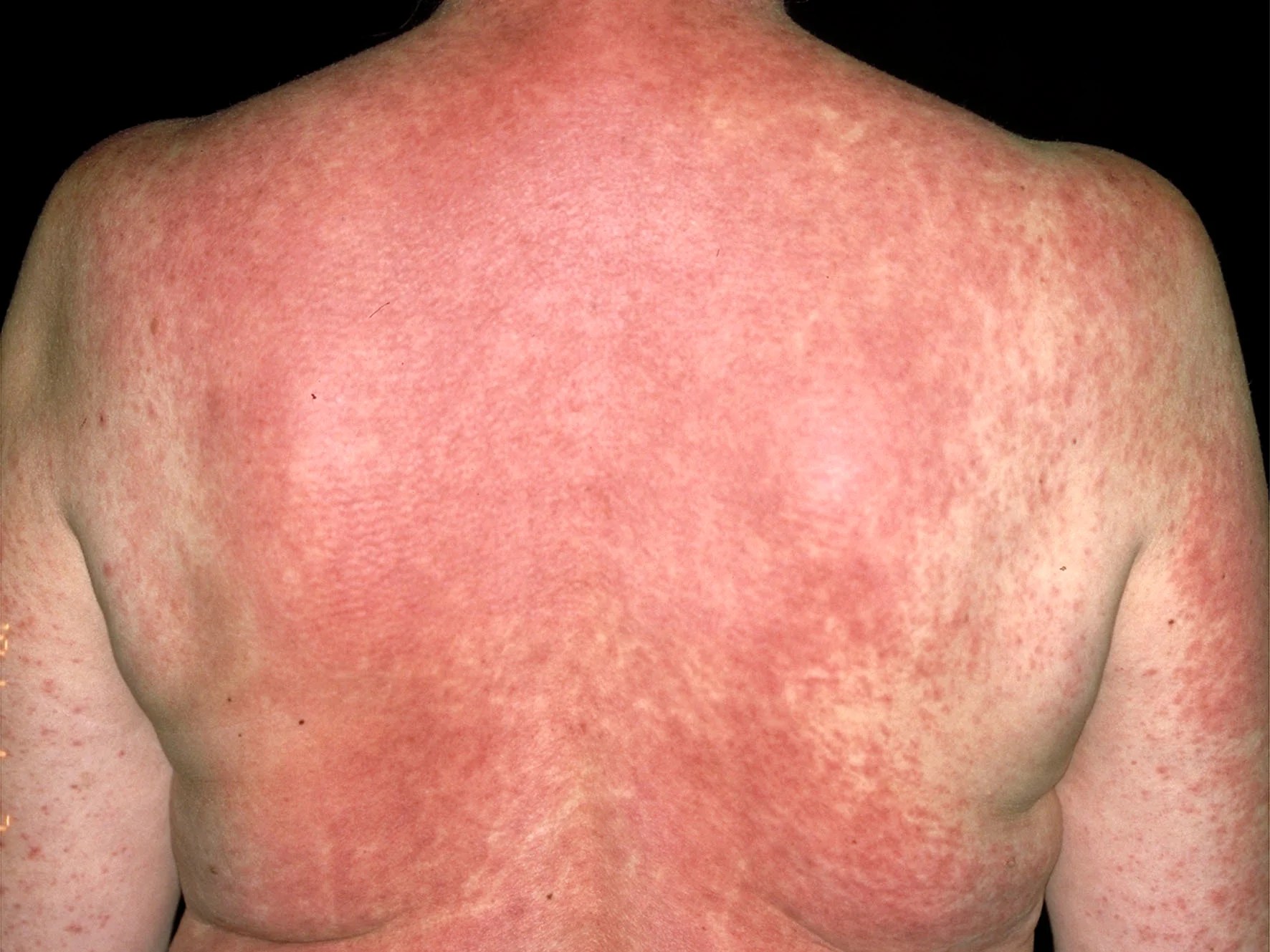 red-ring-rash-on-skin-not-ringworm