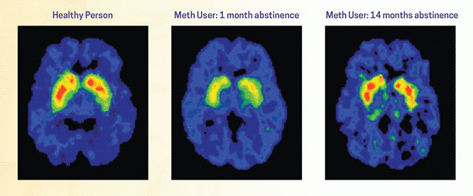 How Long Does It Take to Recover From Addiction?