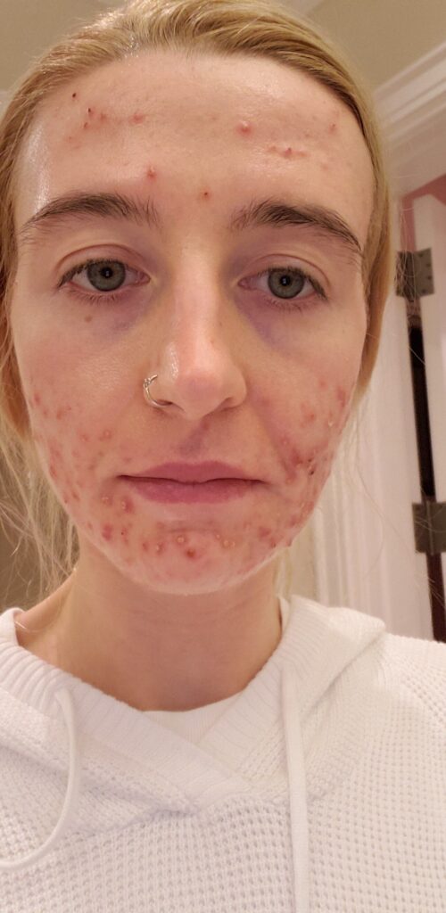 how-long-after-accutane-can-you-drink-alcohol