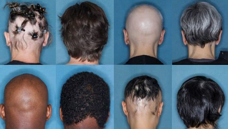 What Drug Causes Hair Loss?