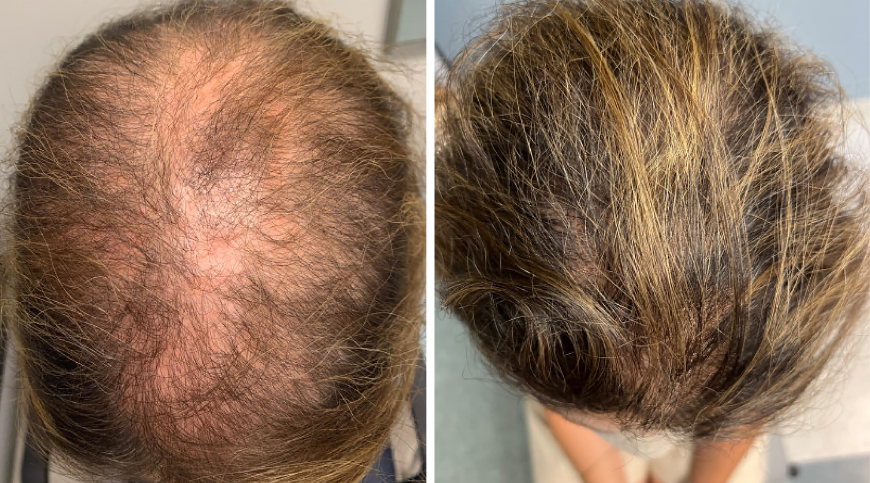 What Drug Causes Hair Loss?